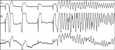 Электрокардиограмма Срыв нормального ритма в состояние трепетания желудочков