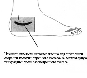 Схема постановки пиявки при коксартрозе тазобедренного сустава